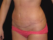 Tummy Tuck After Photo by Jonathan Kramer, MD; Meridian, ID - Case 25701