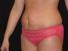 Tummy Tuck Before Photo by Jonathan Kramer, MD; Meridian, ID - Case 25701