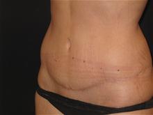 Tummy Tuck After Photo by Jonathan Kramer, MD; Meridian, ID - Case 25701