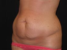 Tummy Tuck Before Photo by Jonathan Kramer, MD; Meridian, ID - Case 25701