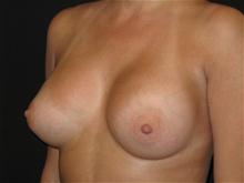 Breast Augmentation After Photo by Jonathan Kramer, MD; Meridian, ID - Case 25929