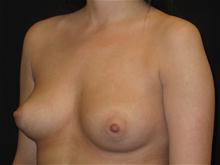 Breast Augmentation Before Photo by Jonathan Kramer, MD; Meridian, ID - Case 25929