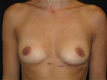 Breast Augmentation Before Photo by Jonathan Kramer, MD; Meridian, ID - Case 25930