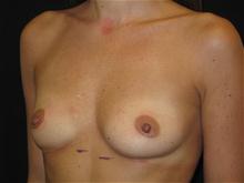 Breast Augmentation Before Photo by Jonathan Kramer, MD; Meridian, ID - Case 25930