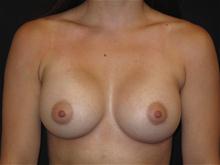 Breast Augmentation After Photo by Jonathan Kramer, MD; Meridian, ID - Case 25966