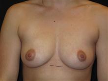 Breast Augmentation Before Photo by Jonathan Kramer, MD; Meridian, ID - Case 25966