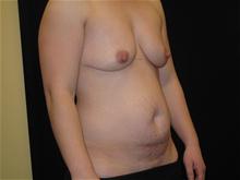 Tummy Tuck Before Photo by Jonathan Kramer, MD; Meridian, ID - Case 26832