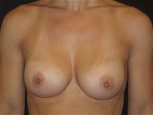 Breast Augmentation After Photo by Jonathan Kramer, MD; Meridian, ID - Case 27408
