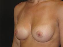 Breast Augmentation After Photo by Jonathan Kramer, MD; Meridian, ID - Case 27408