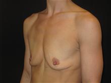 Breast Augmentation Before Photo by Jonathan Kramer, MD; Meridian, ID - Case 27408