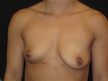 Breast Augmentation Before Photo by Jonathan Kramer, MD; Meridian, ID - Case 29242
