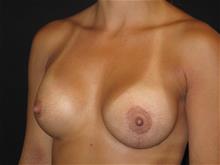 Breast Augmentation After Photo by Jonathan Kramer, MD; Meridian, ID - Case 29242