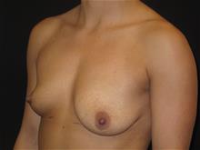 Breast Augmentation Before Photo by Jonathan Kramer, MD; Meridian, ID - Case 29242