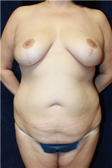 Tummy Tuck Before Photo by Scott Miller, MD; La Jolla, CA - Case 34177