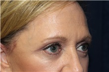 Eyelid Surgery After Photo by Scott Miller, MD; La Jolla, CA - Case 34178