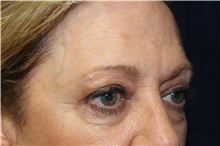 Eyelid Surgery Before Photo by Scott Miller, MD; La Jolla, CA - Case 34178