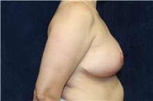 Breast Reduction After Photo by Scott Miller, MD; La Jolla, CA - Case 34179