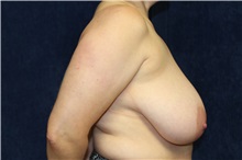 Breast Reduction Before Photo by Scott Miller, MD; La Jolla, CA - Case 34179