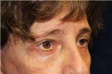 Eyelid Surgery After Photo by Scott Miller, MD; La Jolla, CA - Case 34180