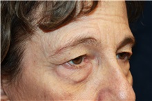 Eyelid Surgery Before Photo by Scott Miller, MD; La Jolla, CA - Case 34180