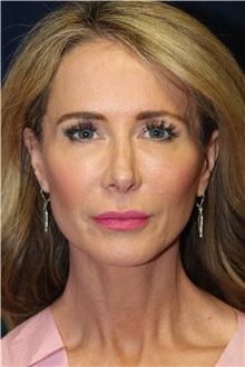 Facelift After Photo by Scott Miller, MD; La Jolla, CA - Case 34181