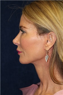 Facelift After Photo by Scott Miller, MD; La Jolla, CA - Case 34181