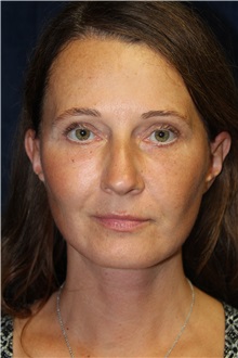 Facelift After Photo by Scott Miller, MD; La Jolla, CA - Case 34184