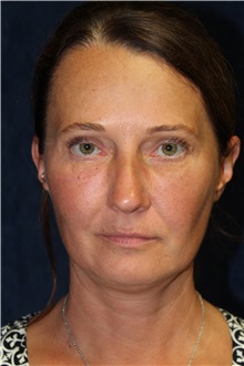 Facelift Before Photo by Scott Miller, MD; La Jolla, CA - Case 34184