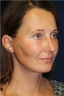 Facelift After Photo by Scott Miller, MD; La Jolla, CA - Case 34184