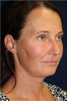 Facelift Before Photo by Scott Miller, MD; La Jolla, CA - Case 34184