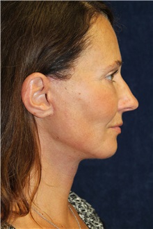 Facelift After Photo by Scott Miller, MD; La Jolla, CA - Case 34184