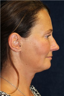 Facelift Before Photo by Scott Miller, MD; La Jolla, CA - Case 34184