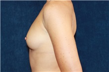 Breast Augmentation Before Photo by Scott Miller, MD; La Jolla, CA - Case 34187