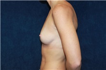 Breast Augmentation Before Photo by Scott Miller, MD; La Jolla, CA - Case 34188