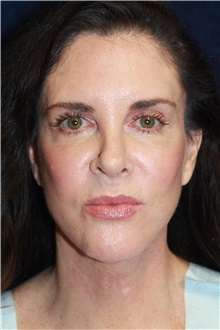 Facelift After Photo by Scott Miller, MD; La Jolla, CA - Case 34191