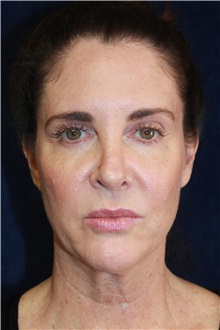 Facelift Before Photo by Scott Miller, MD; La Jolla, CA - Case 34191