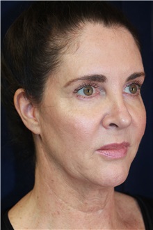 Facelift Before Photo by Scott Miller, MD; La Jolla, CA - Case 34191