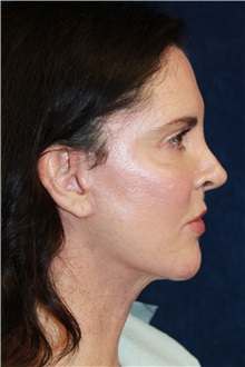 Facelift After Photo by Scott Miller, MD; La Jolla, CA - Case 34191