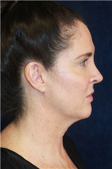 Facelift Before Photo by Scott Miller, MD; La Jolla, CA - Case 34191