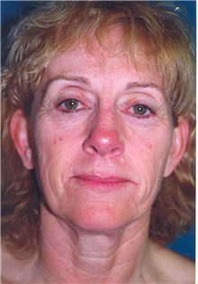 Facelift Before Photo by Scott Miller, MD; La Jolla, CA - Case 8218