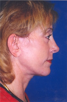 Facelift After Photo by Scott Miller, MD; La Jolla, CA - Case 8218