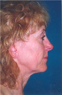 Facelift Before Photo by Scott Miller, MD; La Jolla, CA - Case 8218