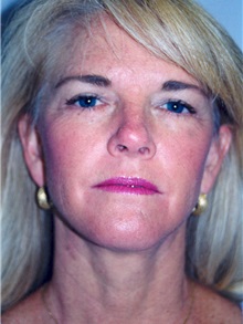 Facelift After Photo by Scott Miller, MD; La Jolla, CA - Case 8221