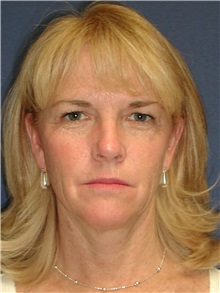 Facelift Before Photo by Scott Miller, MD; La Jolla, CA - Case 8221