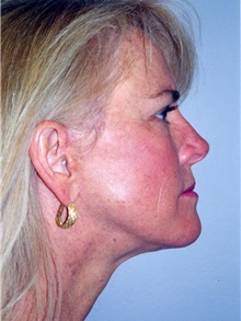 Facelift After Photo by Scott Miller, MD; La Jolla, CA - Case 8221