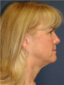 Facelift Before Photo by Scott Miller, MD; La Jolla, CA - Case 8221