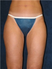 Liposuction After Photo by Scott Miller, MD; La Jolla, CA - Case 8222