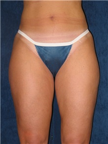 Liposuction Before Photo by Scott Miller, MD; La Jolla, CA - Case 8222