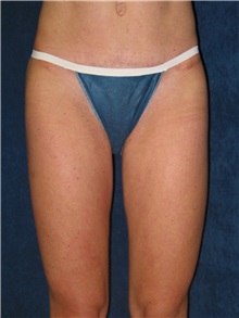 Liposuction After Photo by Scott Miller, MD; La Jolla, CA - Case 8223