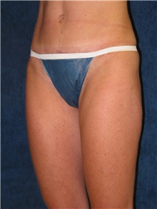 Liposuction Before Photo by Scott Miller, MD; La Jolla, CA - Case 8223